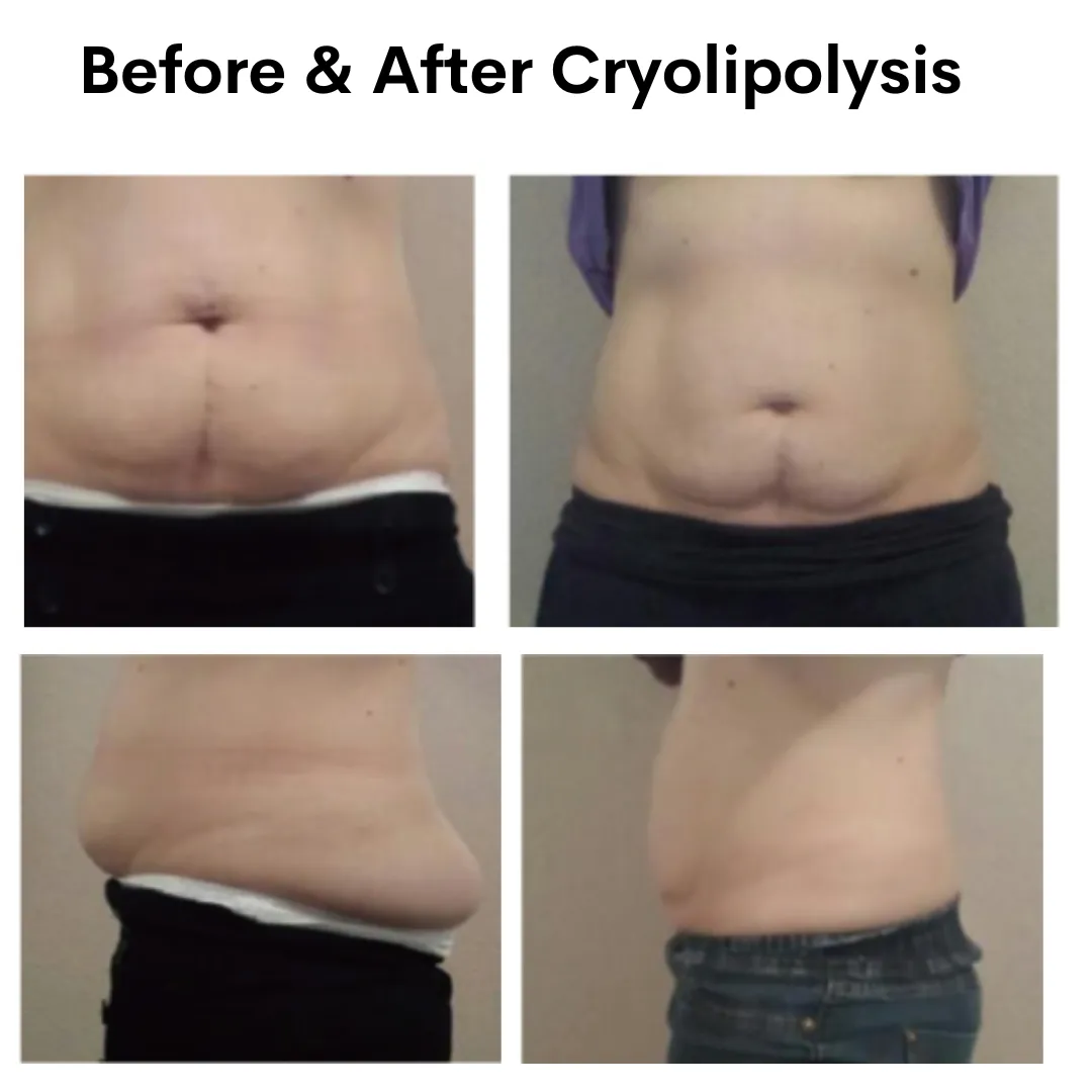 Cryotech Cryolipolysis Weight Loss Machine